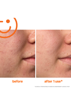 ExfoliKate® Intensive Exfoliating Treatment
