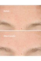 Clarifying Do-Over Peel