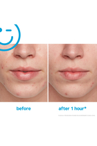 EradiKate® 10% Sulfur Acne Treatment